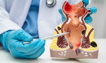 HÉMORROÏDES : cette zone sensible mérite votre attention